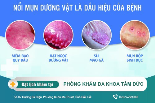 Dương vật nổi mụn trắng nguyên nhân và cách điều trị thế nào?