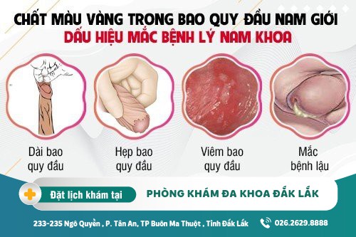 Trong bao quy đầu xuất hiện chất màu vàng là dấu hiệu của bệnh lý gì?