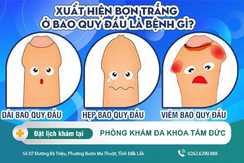 Bợn trắng ở bao quy đầu và những điều cần biết khi có dấu hiệu trên
