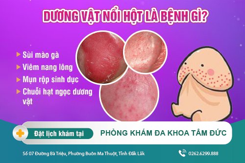 Nổi hột ở dương vật - cách nhận biết bệnh lý nam khoa nguy hiểm