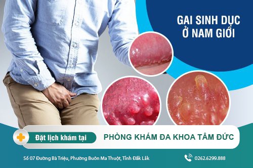 Gai sinh dục ở nam giới xuất hiện khi nào? Các điều cần biết về gai sinh dục