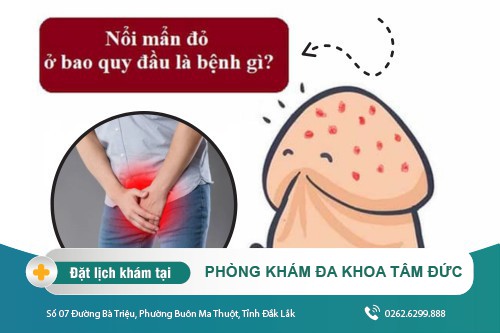 Nổi mẩn đỏ bao quy đầu là bệnh lý gì? Tìm hiểu tại đây nhé!