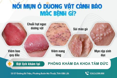 Cảnh giác khi dương vật nổi mụn