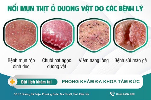Bị nổi mụn thịt ở dương vật - nguyên nhân và cách điều trị