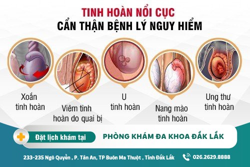 Tinh hoàn nổi cục - Dấu hiệu bệnh nguy hiểm