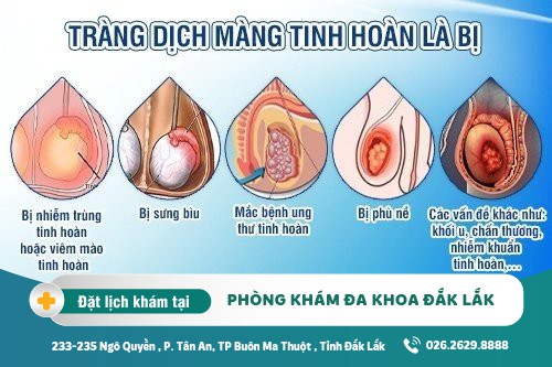 Dấu hiệu Tinh hoàn có nước - tràn dịch màn tinh hoàn và cách điều trị hiện nay